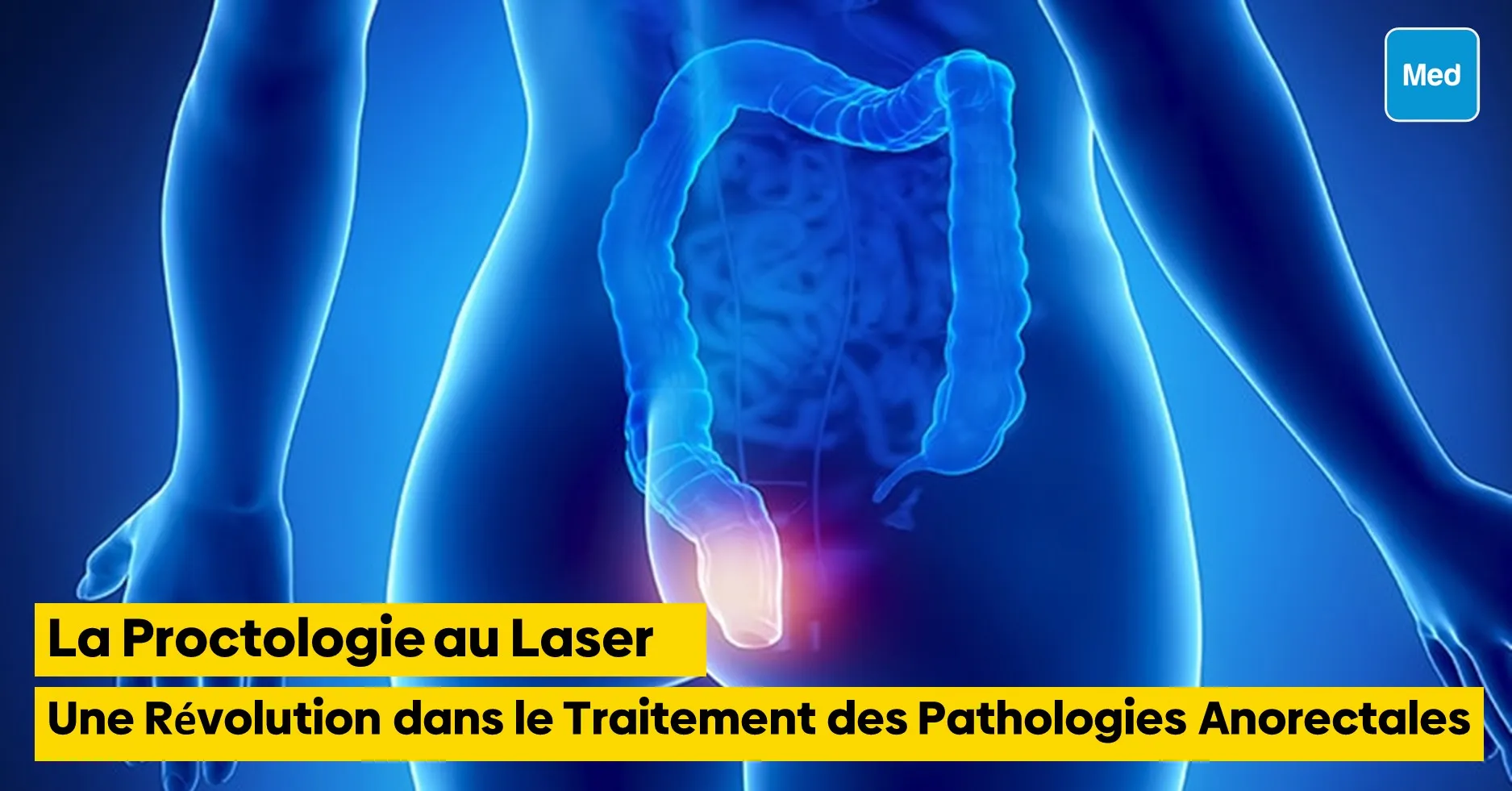 La Proctologie au Laser : Une Révolution dans le Traitement des Pathologies Anorectales